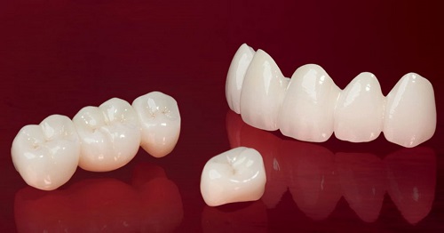 Cách khắc phục răng sứ bị mòn - Tìm hiểu nguyên nhân do đâu 2