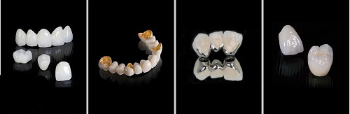 Cách khắc phục răng sứ bị vàng hiệu quả cho bạn 2