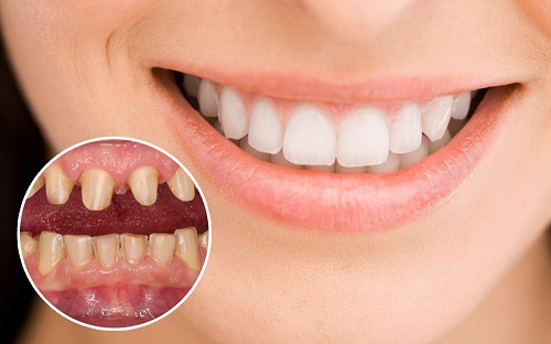Răng sứ có mài được không bác sĩ nha khoa? 2