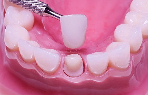 Răng sứ có mài được không bác sĩ nha khoa? 3