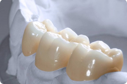 Răng sứ titan có mấy loại hiện nay? Tìm hiểu thông tin 1