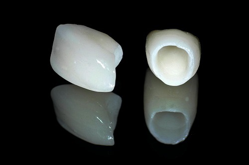 Răng sứ titan có mấy loại hiện nay? Tìm hiểu thông tin 2