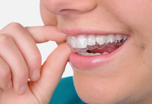Thuốc tẩy trắng răng tại nhà với cách làm nào là hiệu quả? 3
