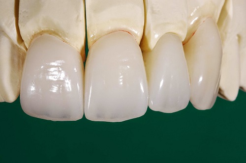 Trồng răng sứ có lâu không? Quy trình thực hiện 1