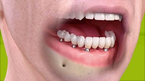 Trồng răng sứ có tốt không? Khi trồng răng sứ cần lưu ý điều gì? 1