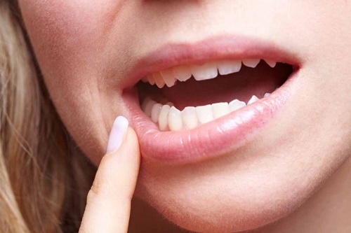 Răng khôn bị lung lay có nên nhổ không? 2
