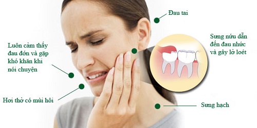 Răng khôn bị lung lay có nên nhổ không? 3