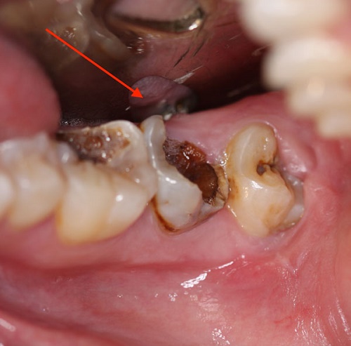 Nhổ răng hàm không đau có thật không? Nhờ nha khoa tư vấn 1