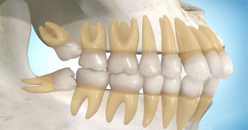 Trường hợp nhổ răng khôn xong bị sốt là do đâu 2 Trường hợp nhổ răng khôn xong bị sốt là do đâu 2