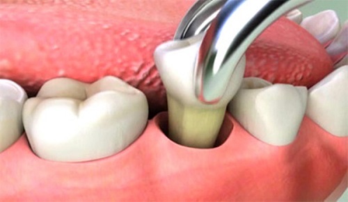 Trường hợp nhổ răng khôn xong bị sốt là do đâu 3 Trường hợp nhổ răng khôn xong bị sốt là do đâu 3