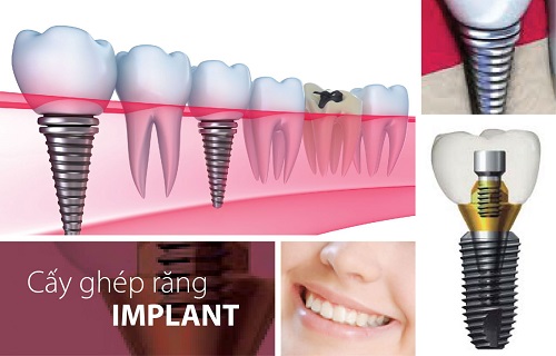 Implant là gì? Kiến thức tổng quát về Implant 2