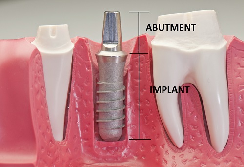 Implant là gì? Kiến thức tổng quát về Implant 3
