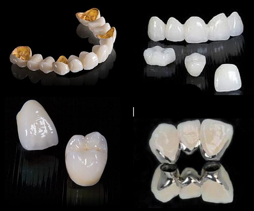 Trồng răng bao nhiêu tiền 1 cái? Giá cả mới nhất  3