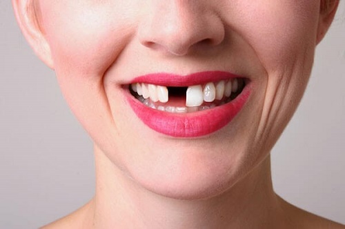 Trồng răng cửa hàm trên cần lưu ý điều gì giúp có kết quả tốt? 1