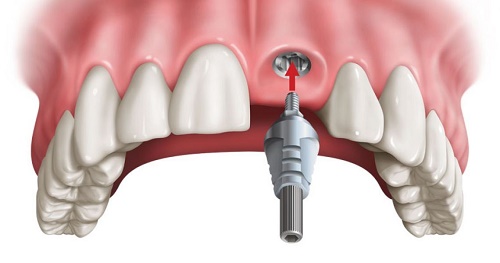 Trồng răng cửa hàm trên cần lưu ý điều gì giúp có kết quả tốt? 2