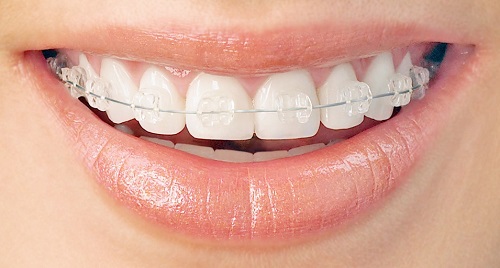 Trồng răng giả có niềng được không? Tham khảo ý kiến bác sĩ 3