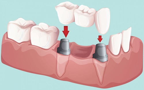 Trồng răng giả có lâu không? Các bước thực hiện 2