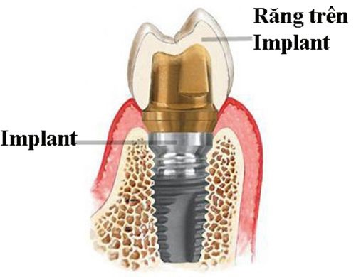 Trồng răng hàm implant giá bao nhiêu? Cập nhật giá mới 3