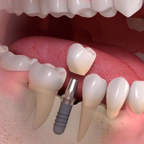 Trồng răng kiêng ăn gì? Thực đơn hoàn chỉnh cho bạn 3