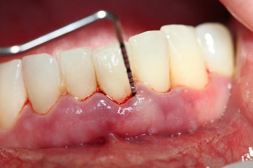 Lấy cao răng có ảnh hưởng không? Tìm hiểu ngay 1
