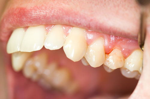 Lấy cao răng có ảnh hưởng không? Tìm hiểu ngay 2