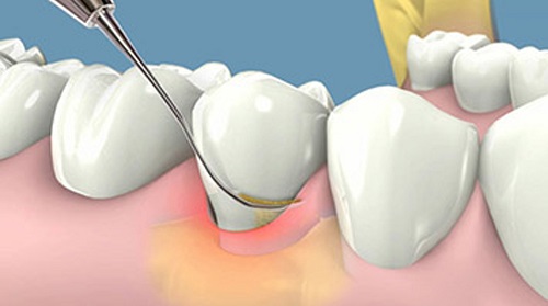 Lấy cao răng có ảnh hưởng không? Tìm hiểu ngay 3
