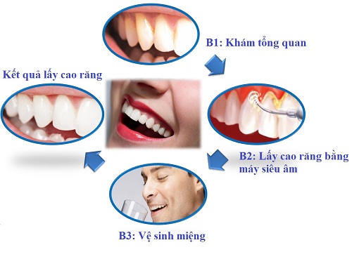 Lấy cao răng ở đâu an toàn? Tìm hiểu ngay 4