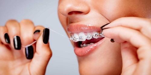Niềng răng ăn uống như thế nào để nhanh hồi phục? 3