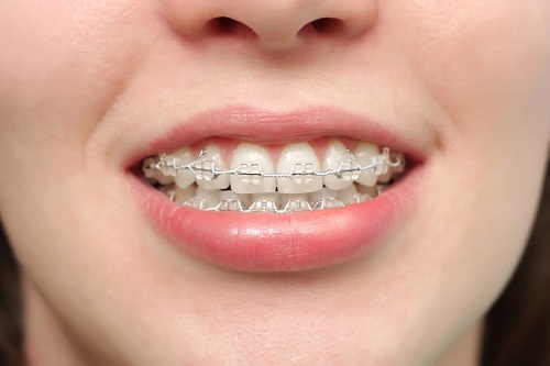 Niềng răng bị sưng lợi - Giải pháp xử lý hiệu quả 1