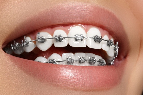 Niềng răng bị sưng lợi - Giải pháp xử lý hiệu quả 2