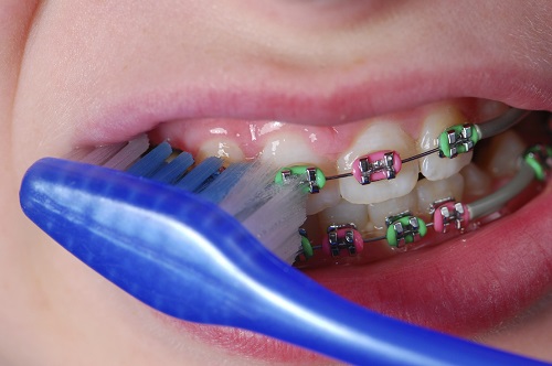 Niềng răng bị sưng lợi - Giải pháp xử lý hiệu quả 3