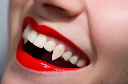 Trồng răng khểnh ở đâu có kết quả tốt cho bạn? 2