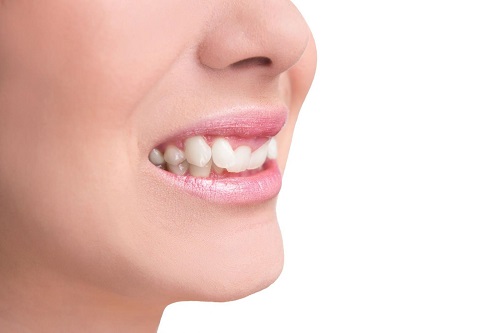 Trồng răng khểnh ở đâu có kết quả tốt cho bạn? 3