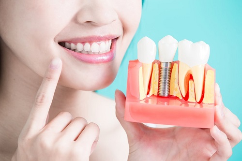 Trồng răng sứ dùng được bao lâu? Tìm hiểu về độ bền 1