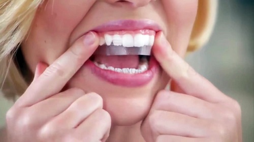 Có nên dùng miếng dán tẩy trắng răng không? 2