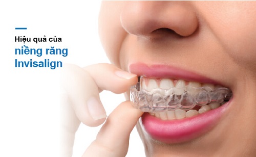Niềng răng invisalign có nhổ răng không? Nha khoa giải đáp 2
