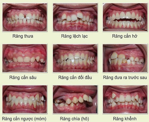 Niềng răng invisalign có nhổ răng không? Nha khoa giải đáp 3