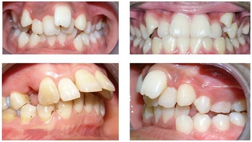 Niềng răng invisalign có nhổ răng không? Nha khoa giải đáp 4