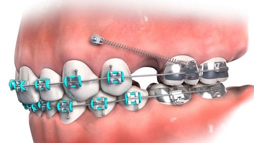 Cắm vít niềng răng bị sưng - Có phải là dấu hiệu bình thường? 2
