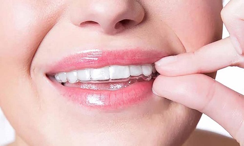 Bọc răng sứ xong có niềng được không? Cần giải đáp 2