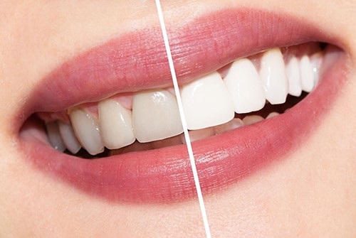 Có nên tẩy trắng răng nhiều lần? Chuyên gia giải đáp 1
