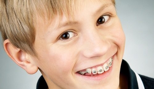 Niềng răng cho trẻ 10 tuổi - Các lưu ý phụ huynh nên biết 1