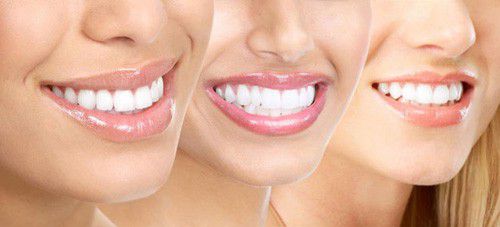 Tẩy trắng răng có an toàn không? Tìm hiểu lý do 1