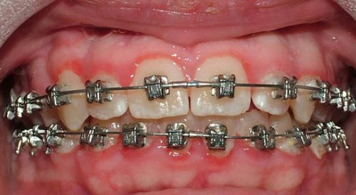 Niềng răng bị viêm lợi - Cách xử lý tại nhà hiệu quả 1