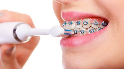 Niềng răng có nên dùng bàn chải điện? Lý do 1