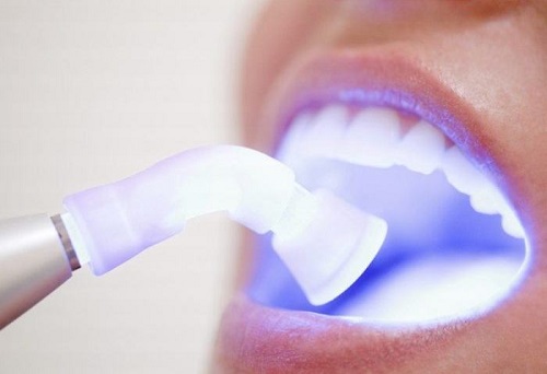 Tẩy trắng răng bằng đèn plasma giá bao nhiêu? Tham khảo 2