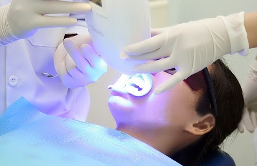 Các thông tin về gel tẩy trắng răng bạn nên biết 3
