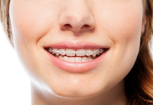 Niềng răng có ảnh hưởng đến sức khỏe không? Tìm hiểu *