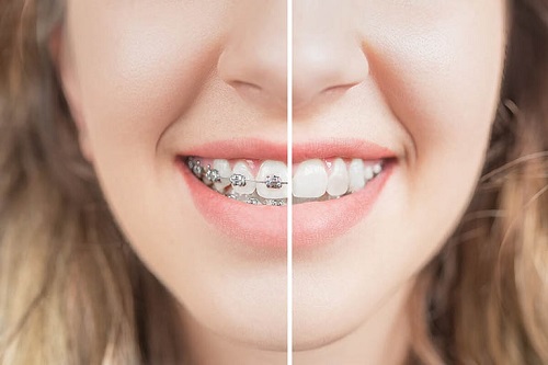 Giải đáp: Niềng răng có ảnh hưởng đến sức khỏe không? *