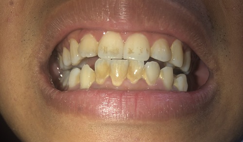 Tẩy trắng răng như thế nào để đạt hiệu quả nhất? 1